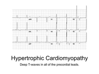 Hypertrophic Cardiomyopathy
Deep T-waves in all of the precordial leads.
 