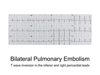 Bilateral Pulmonary Embolism
T wave inversion in the inferior and right pericardial leads
 