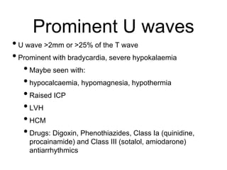 Prominent U waves
•U wave >2mm or >25% of the T wave
•Prominent with bradycardia, severe hypokalaemia
•Maybe seen with:
•hypocalcaemia, hypomagnesia, hypothermia
•Raised ICP
•LVH
•HCM
•Drugs: Digoxin, Phenothiazides, Class Ia (quinidine,
procainamide) and Class III (sotalol, amiodarone)
antiarrhythmics
 