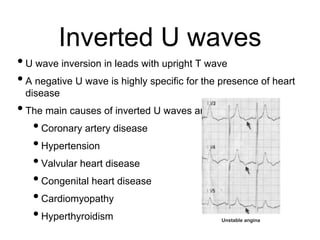 Inverted U waves
•U wave inversion in leads with upright T wave
•A negative U wave is highly specific for the presence of heart
disease
•The main causes of inverted U waves are:
•Coronary artery disease
•Hypertension
•Valvular heart disease
•Congenital heart disease
•Cardiomyopathy
•Hyperthyroidism Unstable angina
 