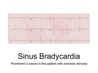 Sinus Bradycardia
Prominent U waves in this patient with anorexia nervosa
 