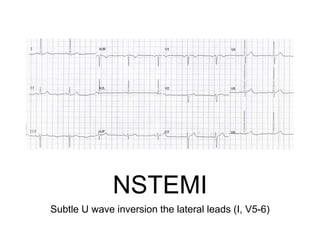 NSTEMI
Subtle U wave inversion the lateral leads (I, V5-6)
 