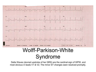 Wolff-Parkison-White
Syndrome
Delta Waves (slurred upstroke of her QRS) are the cardinal sign of WPW, and
most obvious in leads V1 & V2. The minor ST changes seen resolved promptly.
 