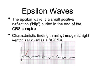 Epsilon Waves
• The epsilon wave is a small positive
deflection (‘blip’) buried in the end of the
QRS complex.
• Characteristic finding in arrhythmogenic right
ventricular dysplasia (ARVD).
 