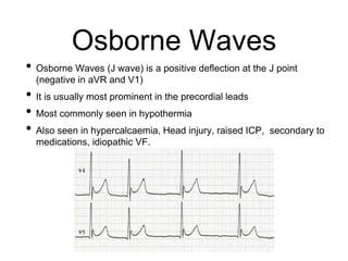 Osborne Waves
• Osborne Waves (J wave) is a positive deflection at the J point
(negative in aVR and V1)
• It is usually most prominent in the precordial leads
• Most commonly seen in hypothermia
• Also seen in hypercalcaemia, Head injury, raised ICP, secondary to
medications, idiopathic VF.
 