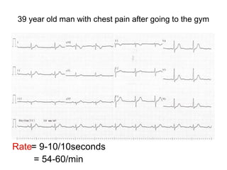39 year old man with chest pain after going to the gym
Rate= 9-10/10seconds
= 54-60/min
 