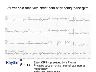39 year old man with chest pain after going to the gym
Rhythm
=
Sinus
Every QRS is preceded by a P-wave
P-waves appear normal; normal axis normal
morphology
 