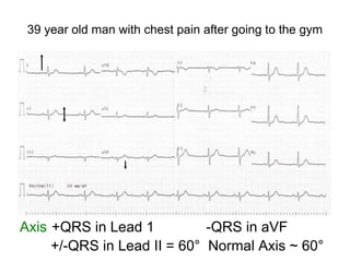 39 year old man with chest pain after going to the gym
Axis +QRS in Lead 1 -QRS in aVF
+/-QRS in Lead II = 60° Normal Axis ~ 60°
 