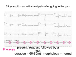 39 year old man with chest pain after going to the gym
P waves
present, regular, followed by a
QRS
duration = 60-80ms,morphology = normal
 