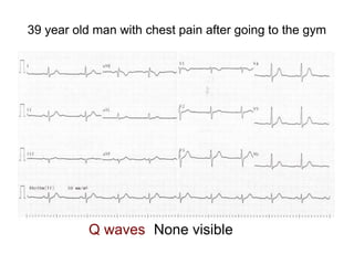 39 year old man with chest pain after going to the gym
Q waves None visible
 