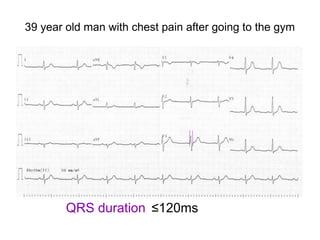 39 year old man with chest pain after going to the gym
QRS duration ≤120ms
 