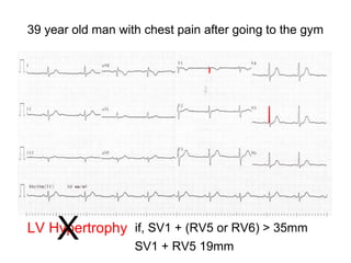 39 year old man with chest pain after going to the gym
LV Hypertrophy if, SV1 + (RV5 or RV6) > 35mm
SV1 + RV5 19mm
X
 