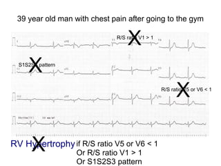 39 year old man with chest pain after going to the gym
RV Hypertrophyif R/S ratio V5 or V6 < 1
X
Or R/S ratio V1 > 1
Or S1S2S3 pattern
R/S ratio V5 or V6 < 1
X
R/S ratio V1 > 1
X
S1S2S3 pattern
X
 