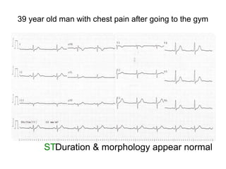 39 year old man with chest pain after going to the gym
STDuration & morphology appear normal
 