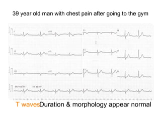 39 year old man with chest pain after going to the gym
T wavesDuration & morphology appear normal
 