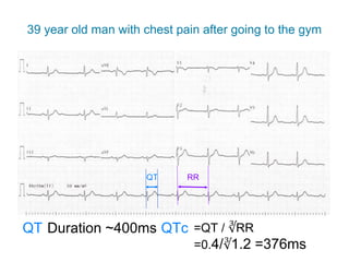 39 year old man with chest pain after going to the gym
QT Duration ~400ms QTc =QT / ∛RR
RRQT
=0.4/∛1.2 =376ms
 