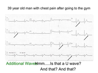 39 year old man with chest pain after going to the gym
Additional WavesHmm.....Is that a U wave?
And that? And that?
 