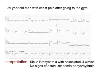 39 year old man with chest pain after going to the gym
Interpretation: Sinus Bradycardia with associated U waves
No signs of acute ischaemia or dysrhythmia
 