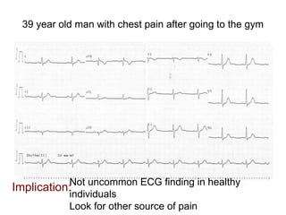 39 year old man with chest pain after going to the gym
Implication:Not uncommon ECG finding in healthy
individuals
Look for other source of pain
 