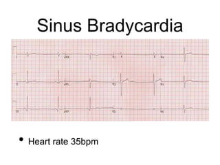 Sinus Bradycardia
• Heart rate 35bpm
 