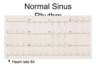 Normal Sinus
Rhythm
• Heart rate 84
 