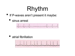 Rhythm
• If P-waves aren’t present it maybe:
• sinus arrest
• atrial fibrillation
 