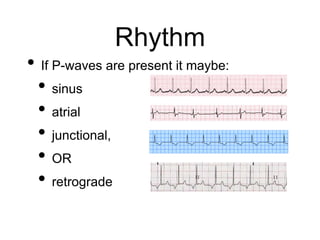 Rhythm
• If P-waves are present it maybe:
• sinus
• atrial
• junctional,
• OR
• retrograde
 