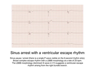 Sinus arrest with a ventricular escape rhythm
Sinus pause / arrest (there is a single P wave visible on the 6-second rhythm strip).
Broad complex escape rhythm with a LBBB morphology at a rate of 25 bpm.
The LBBB morphology (dominant S wave in V1) suggests a ventricular escape
rhythm arising from the right bundle branch.
 