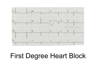First Degree Heart Block
 