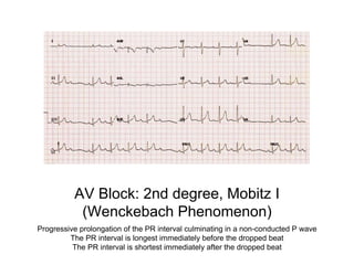 AV Block: 2nd degree, Mobitz I
(Wenckebach Phenomenon)
Progressive prolongation of the PR interval culminating in a non-conducted P wave
The PR interval is longest immediately before the dropped beat
The PR interval is shortest immediately after the dropped beat
 