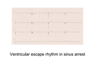 Ventricular escape rhythm in sinus arrest
 