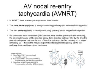 AV nodal re-entry
tachycardia (AVNRT)
• In AVNRT, there are two pathways within the AV node:
• The slow pathway (alpha): a slowly-conducting pathway with a short refractory period.
• The fast pathway (beta): a rapidly-conducting pathway with a long refractory period.
• If a premature atrial contraction (PAC) arrives while the fast pathway is still refractory,
the electrical impulse will be directed solely down the slow pathway (1). By the time the
premature impulse reaches the end of the slow pathway, the fast pathway is no longer
refractory (2) — hence the impulse is permitted to recycle retrogradely up the fast
pathway, thus creating a circus movement
Three Subtypes
1 Slow-Fast AVNRT (common type)
no visible p waves
2 Fast-Slow AVNRT (Uncommon AVNRT)
P waves visible after the QRS complexes
3 Slow-Slow AVNRT (Atypical AVNRT)
P waves visible before the QRS complexes
 