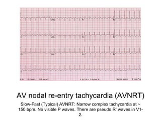 AV nodal re-entry tachycardia (AVNRT)
Slow-Fast (Typical) AVNRT: Narrow complex tachycardia at ~
150 bpm. No visible P waves. There are pseudo R’ waves in V1-
2.
 
