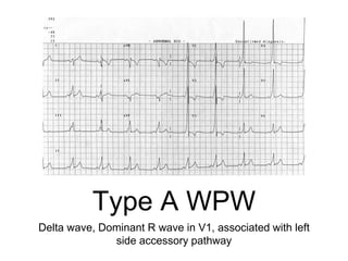 Type A WPW
Delta wave, Dominant R wave in V1, associated with left
side accessory pathway
 