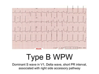 Type B WPW
Dominant S wave in V1, Delta wave, short PR interval,
associated with right side accessory pathway
 