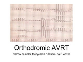 Orthodromic AVRT
Narrow complex tachycardia 180bpm, no P waves
 