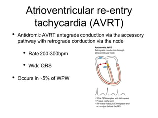 Atrioventricular re-entry
tachycardia (AVRT)
• Antidromic AVRT antegrade conduction via the accessory
pathway with retrograde conduction via the node
• Rate 200-300bpm
• Wide QRS
• Occurs in ~5% of WPW
 
