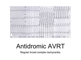 Antidromic AVRT
Regular broad complex tachycardia,
 