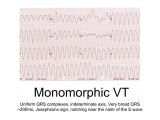 Monomorphic VT
Uniform QRS complexes, indeterminate axis, Very broad QRS
~200ms, Josephsons sign, notching near the nadir of the S wave
 