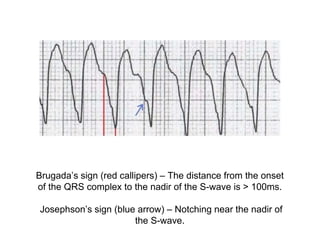 Brugada’s sign (red callipers) – The distance from the onset
of the QRS complex to the nadir of the S-wave is > 100ms.
Josephson’s sign (blue arrow) – Notching near the nadir of
the S-wave.
 