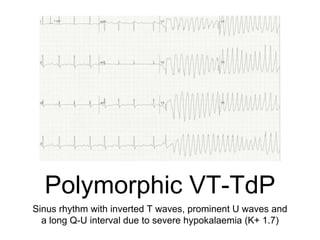 Polymorphic VT-TdP
Sinus rhythm with inverted T waves, prominent U waves and
a long Q-U interval due to severe hypokalaemia (K+ 1.7)
 