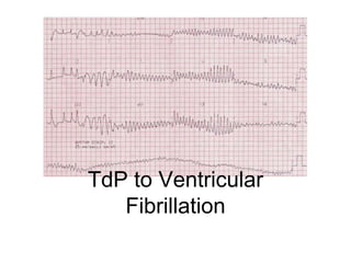 TdP to Ventricular
Fibrillation
 