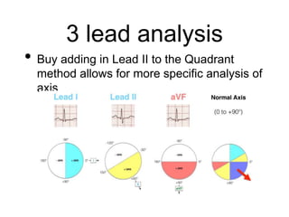 3 lead analysis
• Buy adding in Lead II to the Quadrant
method allows for more specific analysis of
axis
 
