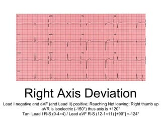Right Axis Deviation
Lead I negative and aVF (and Lead II) positive; Reaching Not leaving; Right thumb up
aVR is isoelectric (-150°) thus axis is +120°
Tan- Lead I R-S (0-4=4) / Lead aVF R-S (12-1=11) [+90°] =-124°
 