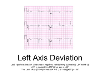 Left Axis Deviation
Lead I positive and aVF (and Lead II) negative; Not reaching but leaving; Left thumb up
aVR is isoelectric (-150°) thus axis is -60°
Tan- Lead I R-S (0-4=4) / Lead aVF R-S (12-1=11) [+90°]=-124°
 