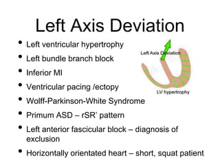 Left Axis Deviation
• Left ventricular hypertrophy
• Left bundle branch block
• Inferior MI
• Ventricular pacing /ectopy
• Wolff-Parkinson-White Syndrome
• Primum ASD – rSR’ pattern
• Left anterior fascicular block – diagnosis of
exclusion
• Horizontally orientated heart – short, squat patient
 
