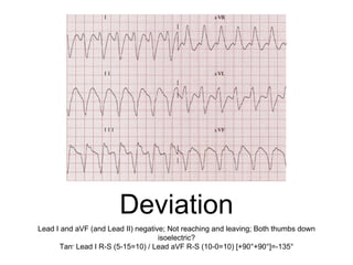 Extreme Axis
Deviation
Lead I and aVF (and Lead II) negative; Not reaching and leaving; Both thumbs down
isoelectric?
Tan- Lead I R-S (5-15=10) / Lead aVF R-S (10-0=10) [+90°+90°]=-135°
 