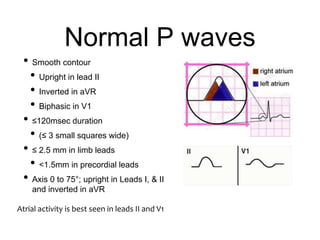 Normal P waves
• Smooth contour
• Upright in lead II
• Inverted in aVR
• Biphasic in V1
• ≤120msec duration
• (≤ 3 small squares wide)
• ≤ 2.5 mm in limb leads
• <1.5mm in precordial leads
• Axis 0 to 75°; upright in Leads I, & II
and inverted in aVR
Atrial activity is best seen in leads II and V1
 