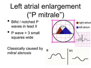 Left atrial enlargement
(“P mitrale”)
• Bifid / notched P
waves in lead II
• P wave > 3 small
squares wide
Classically caused by
mitral stenosis
 