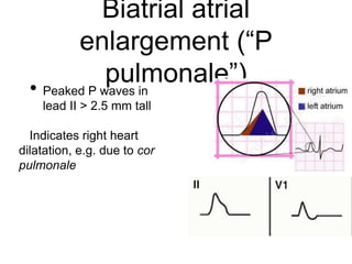 Biatrial atrial
enlargement (“P
pulmonale”)• Peaked P waves in
lead II > 2.5 mm tall
Indicates right heart
dilatation, e.g. due to cor
pulmonale
 